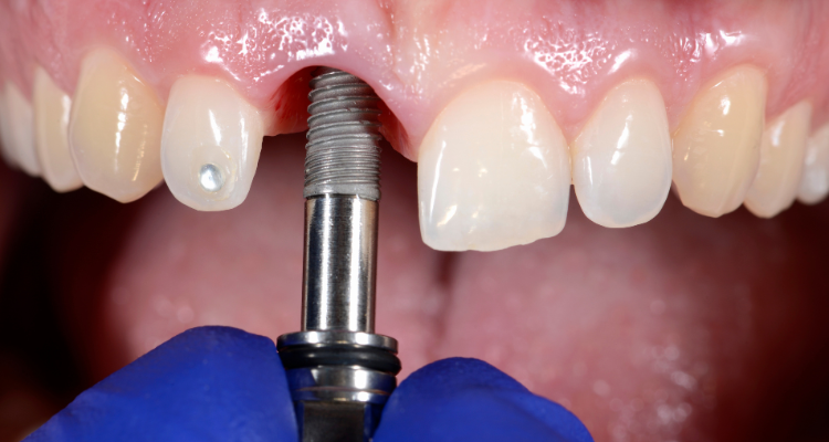 Dental Implant