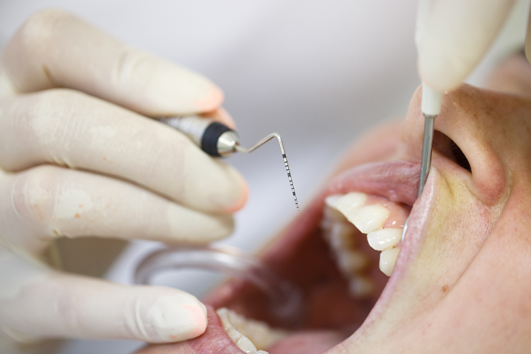 Periodontal flap surgery