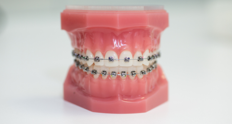 Orthodontic Braces (Metal, Ceramic) Specific - invisalign