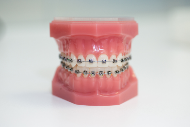 Orthodontic Braces (Metal, Ceramic) Specific - invisalign