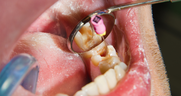 Root Canal Treatment (R.C.T)
