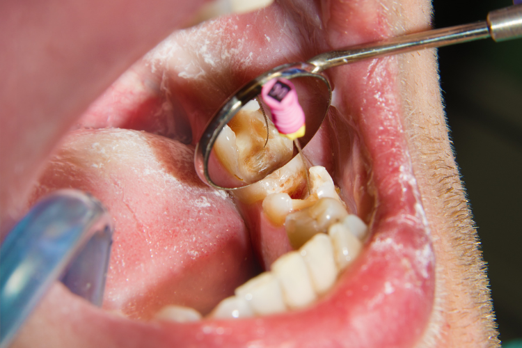 Root Canal Treatment (R.C.T)