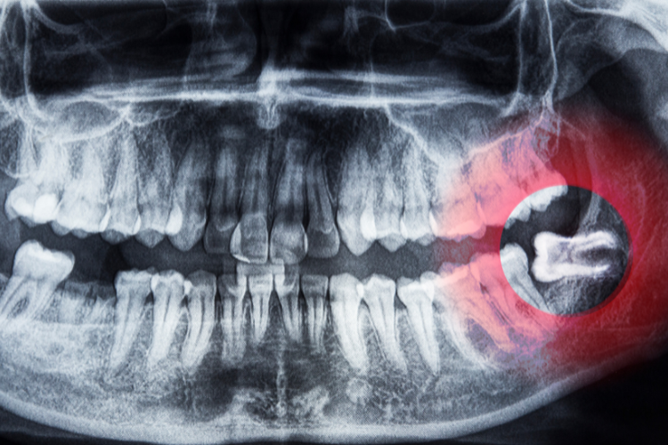Wisdom tooth Surgery