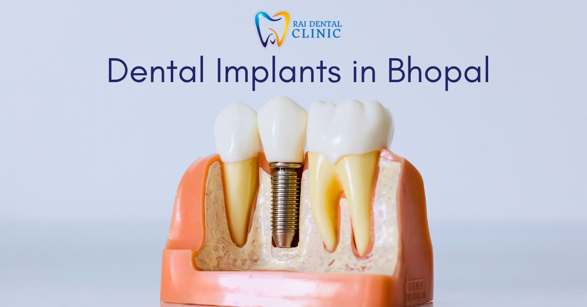 Dental Implants in Bhopal