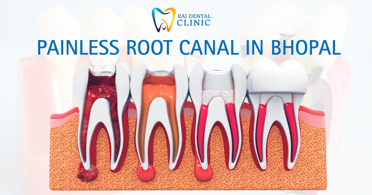 Painless root canal in Bhopal